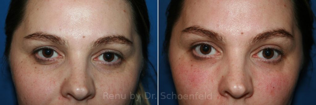 Dermal Filler Photos Chevy Chase Md Patient