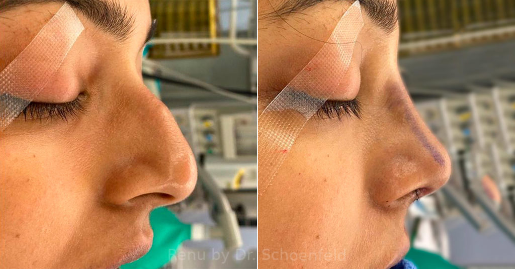 Rhinoplasty Photos Chevy Chase Md Patient