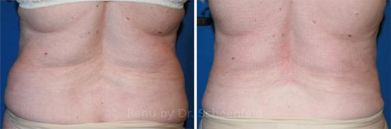 Slimlipo Laser Liposuction Photos Chevy Chase Md Patient