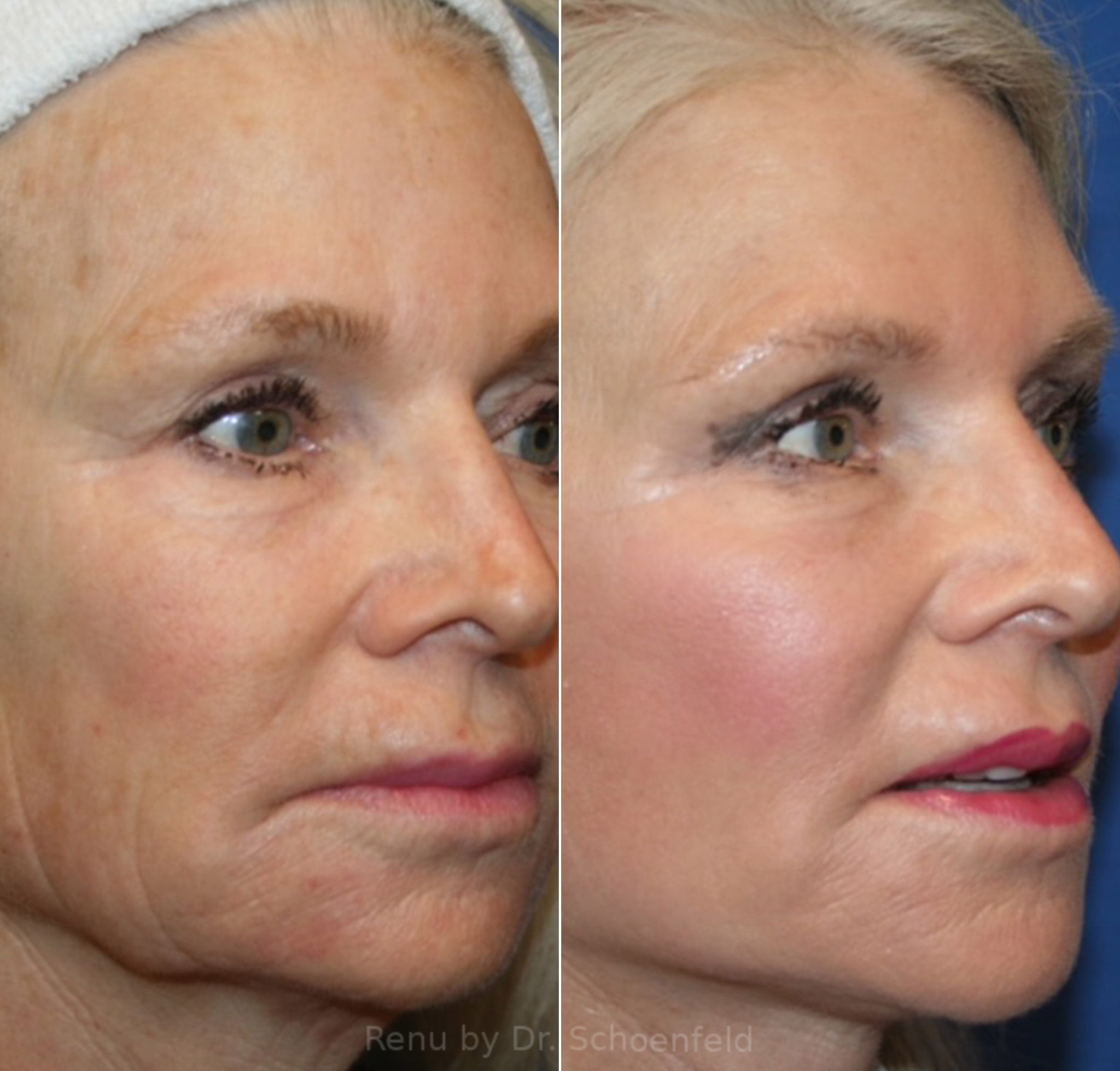 Facelift Photos Chevy Chase Md Patient 14149 4348