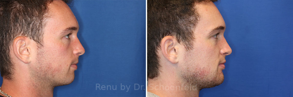 chin implant before and after