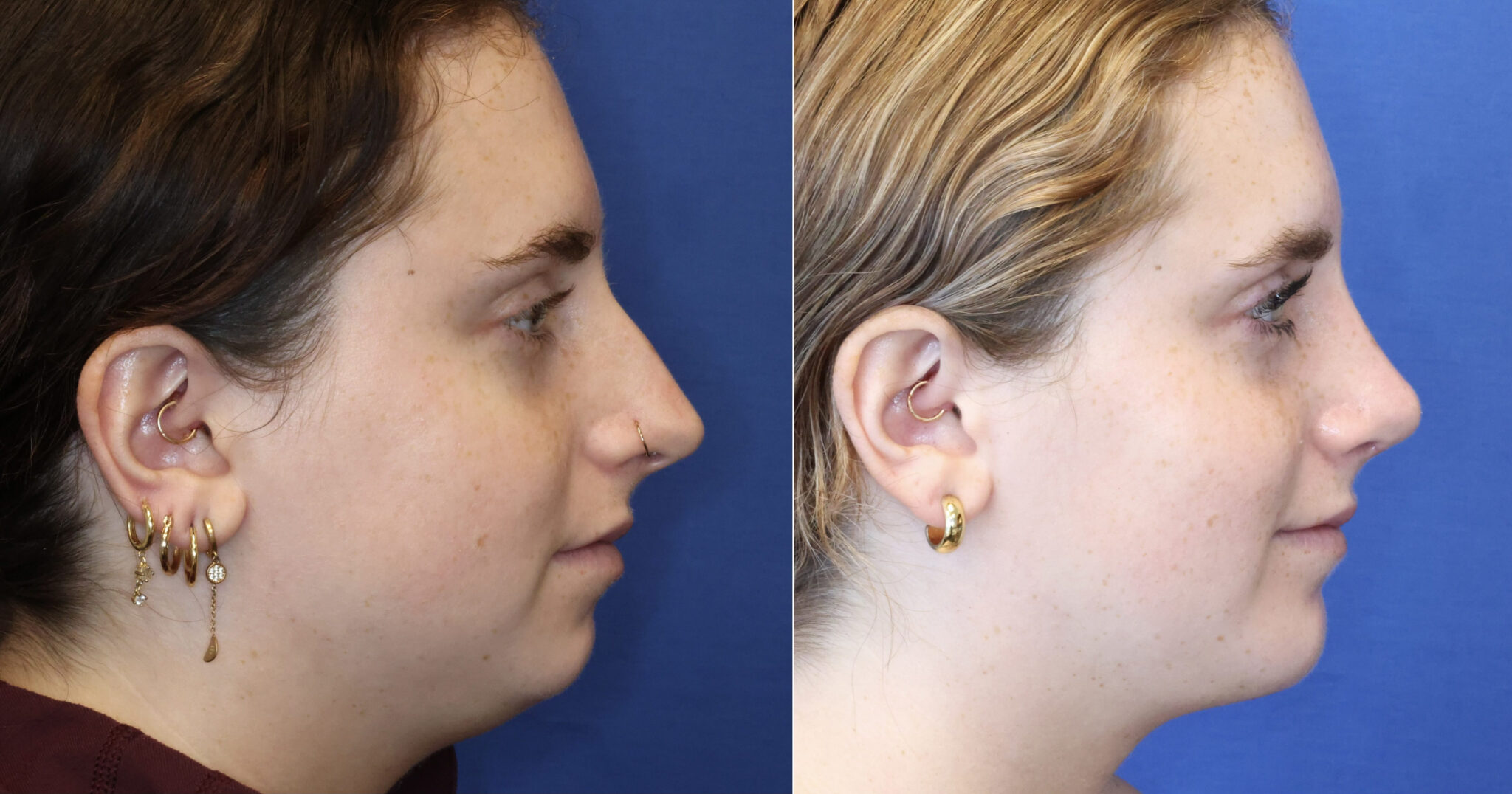 Buccal Fat Removal Photos Plastic Surgery Washington Dc 3422