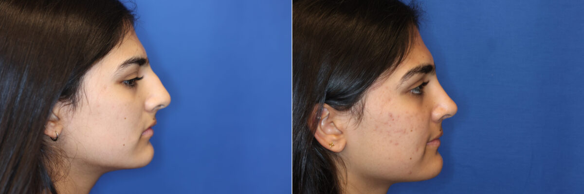 Rhinoplasty Before and After Photos in DC, Patient 14735