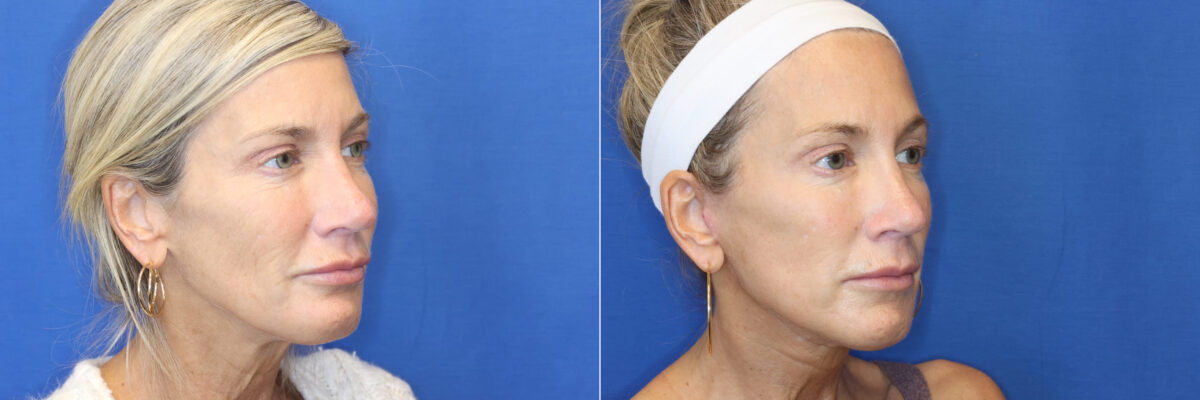 Rhinoplasty Before and After Photos in DC, Patient 14741