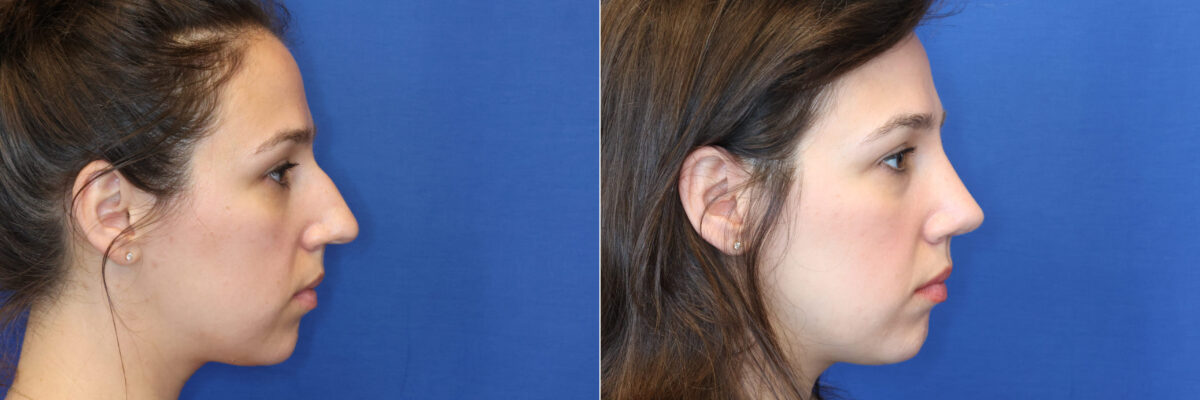 Rhinoplasty Before and After Photos in DC, Patient 14787