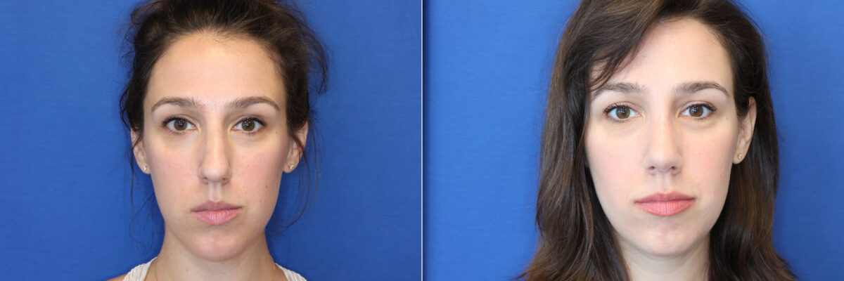 Rhinoplasty Before and After Photos in DC, Patient 14787