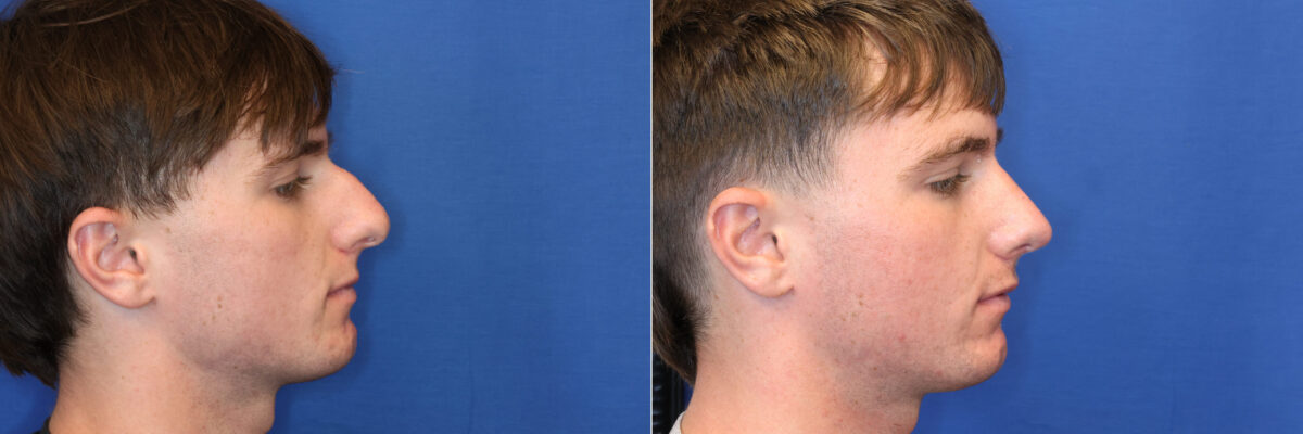 Rhinoplasty Before and After Photos in DC, Patient 14796