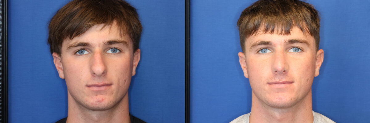 Rhinoplasty Before and After Photos in DC, Patient 14796