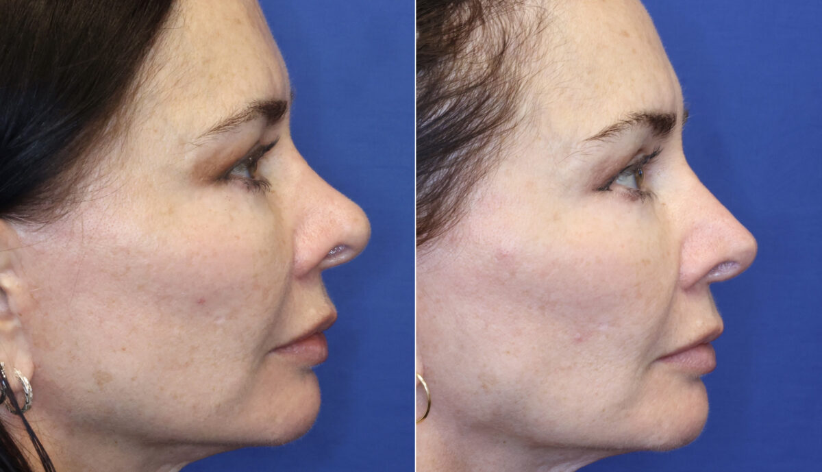 Revision Rhinoplasty Before and After Photos in DC, Patient 14814