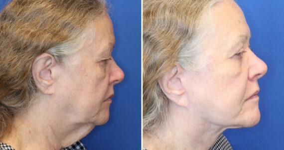 Deep Neck Lift Before and After Photos in Chevy Chase, MD