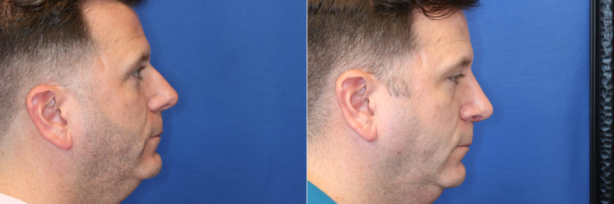 Rhinoplasty Before and After Photos in DC, Patient 14858