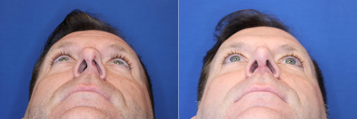 Rhinoplasty Before and After Photos in DC, Patient 14858