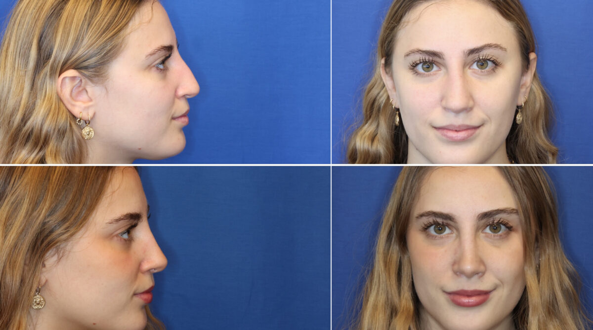 Rhinoplasty Before and After Photos in DC, Patient 15117